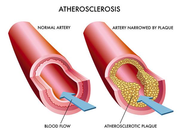 Artherosclerosis-e1464198437578