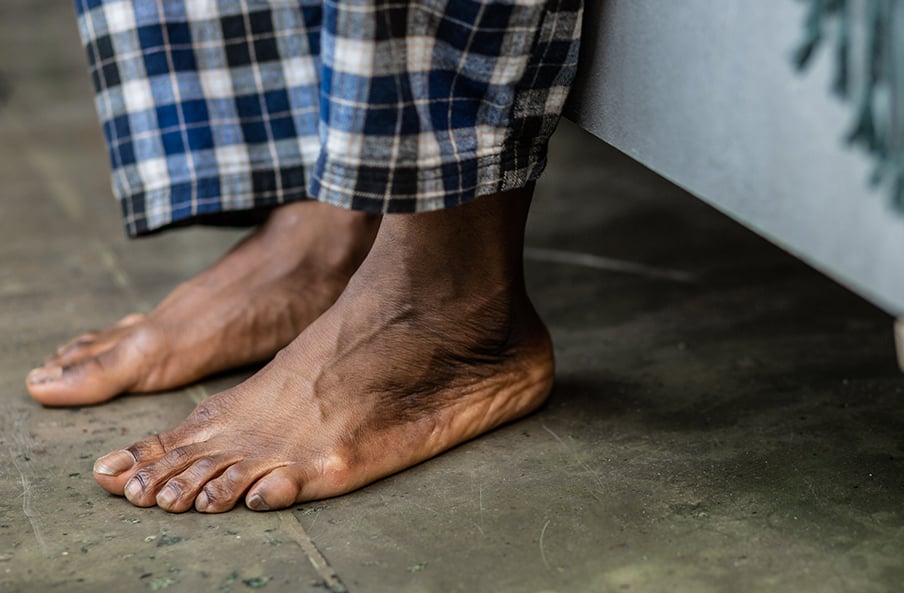 Study Finds Black Men And Women Have A 30 Higher Risk For Developing   Black Feet Diabetic Foot 