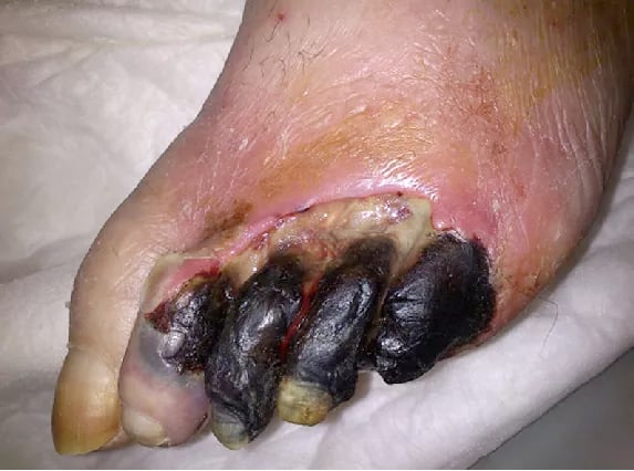 Three_Gangrene_Toes