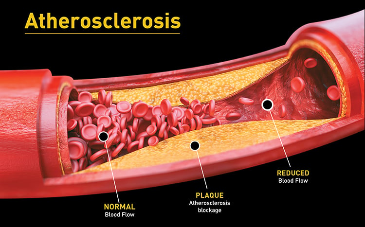 Erectile Dysfunction and Peripheral Artery Disease