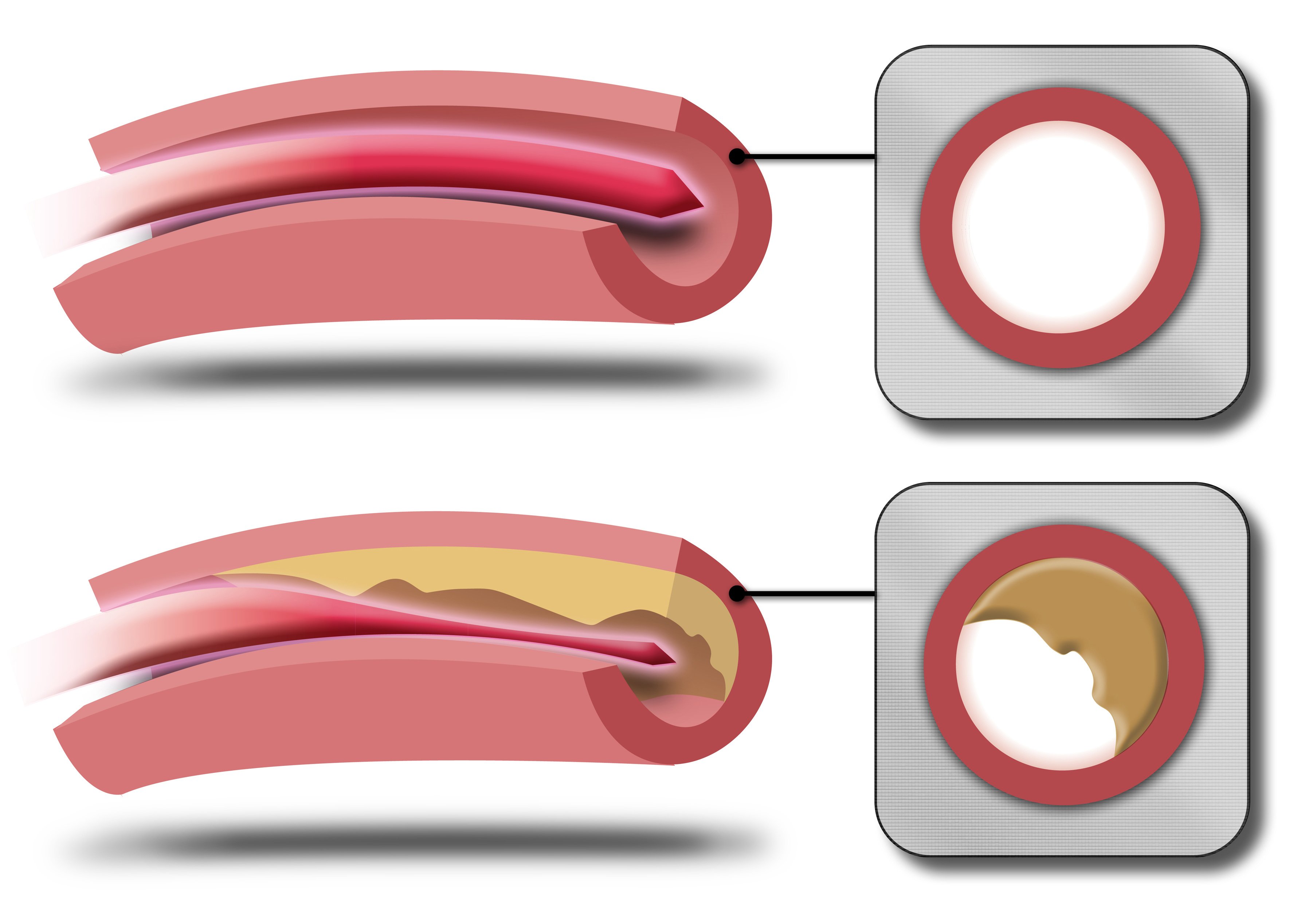 avinger.com_blocked_artery