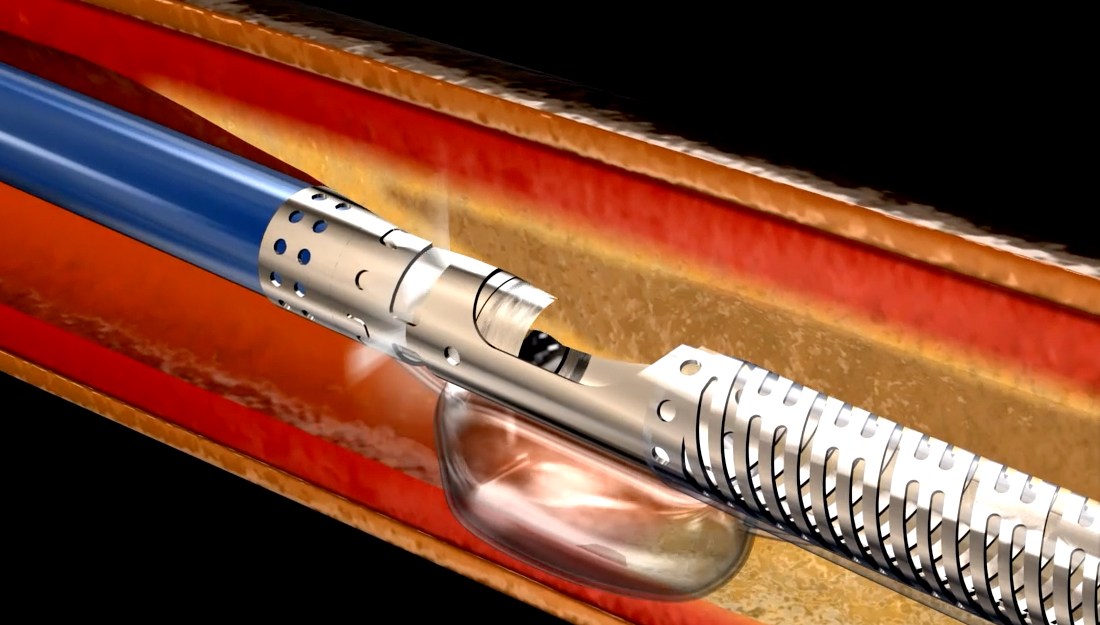 eximo laser atherectomy