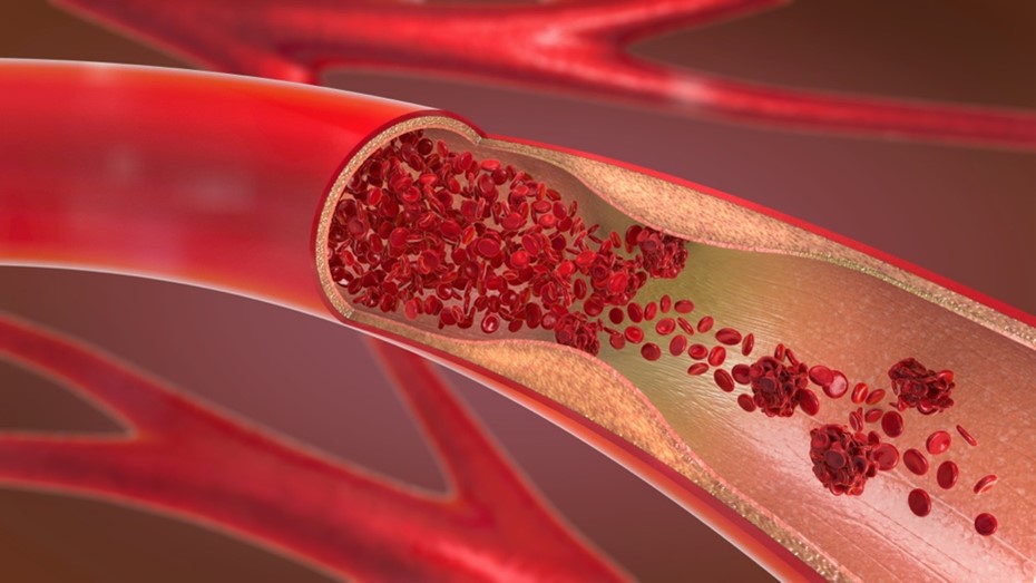 peripheral-artery-disease-blog