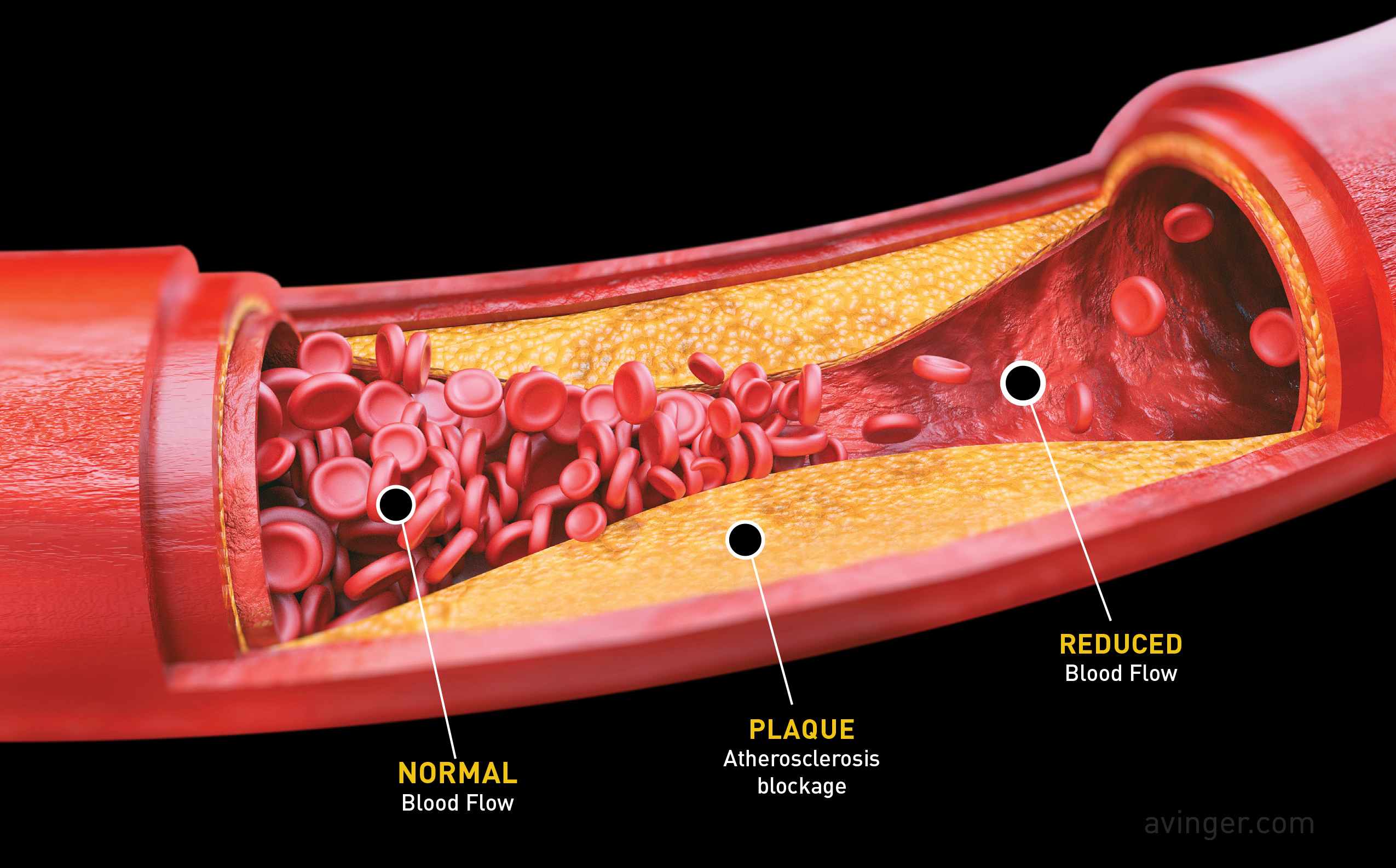 What Is Peripheral Artery Disease?