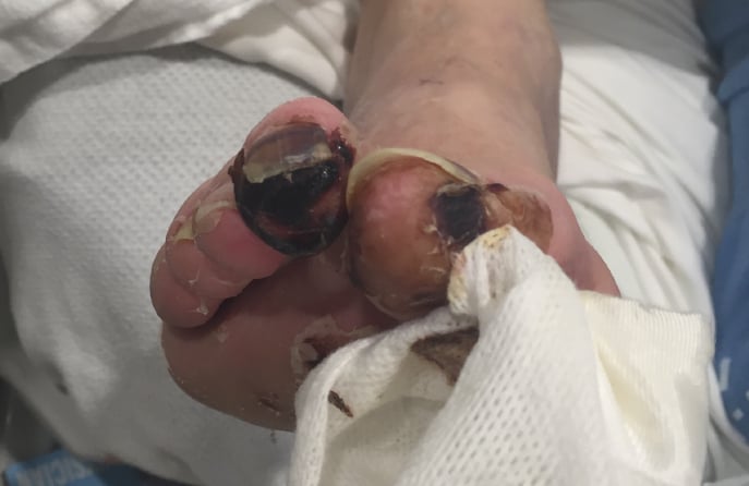 gangrene_toes_before