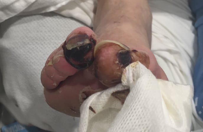 Gangrene on the Foot: Causes, Symptoms, Risks and How to Treat
